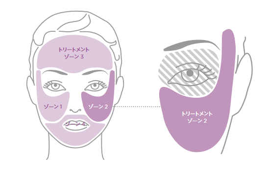 トリアエイジングケアレーザーのトリートメントゾーン説明図